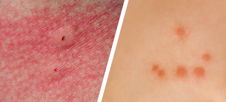 Spider Bites vs Bed Bug Bites: How to Tell the Difference